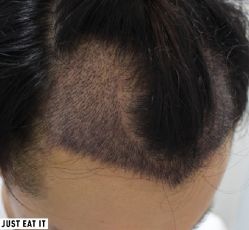 -大麦微针植发丨全国连锁