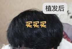 -大麦微针植发全国连锁