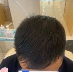 -大麦微针植发丨全国连锁