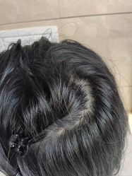 -碧莲盛·不剃发植发