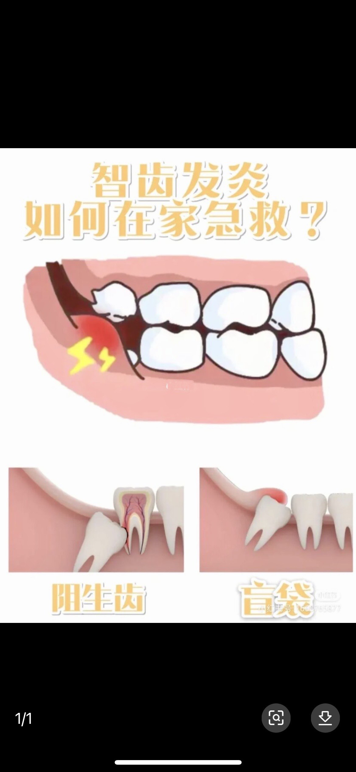 智齿盲袋冲洗步骤图图片