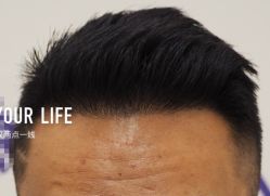 -大麦微针植发全国连锁