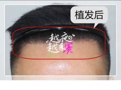 -大麦微针植发全国连锁
