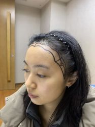 -大麦微针植发全国连锁