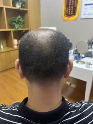 -大麦微针植发全国连锁