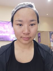 体验前-苏州卫康美容医院