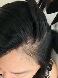 -润复丝·泽发防脱头皮管理