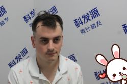 点击看大图 -大麦微针植发丨全国连锁