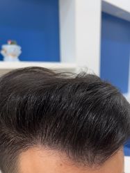 -大麦微针植发全国连锁