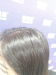 -碧莲盛·不剃发植发