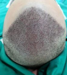 -大麦微针植发丨全国连锁