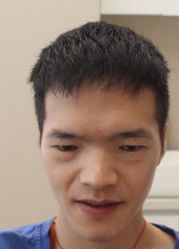 -大麦微针植发全国连锁