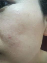 体验后-石家庄苏亚美联臣医疗美容医院
