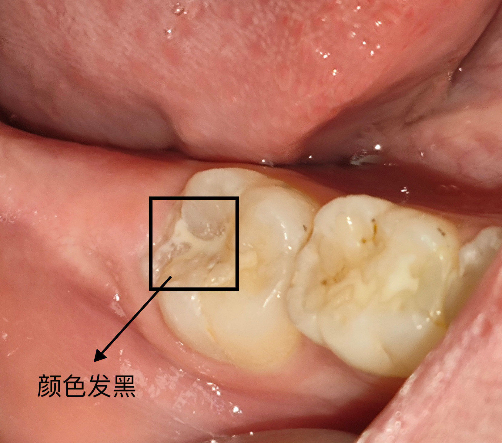 虫牙