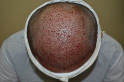 -大麦微针植发丨全国连锁