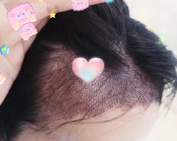 -大麦微针植发全国连锁