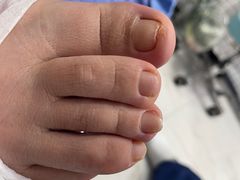 -Andrew指甲专科灰指甲·甲沟炎矫正·3D步态矫形鞋垫定制(浦三路店)