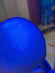 -碧莲盛·不剃发植发