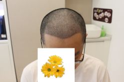 -大麦微针植发丨全国连锁