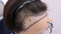 -大麦微针植发丨全国连锁