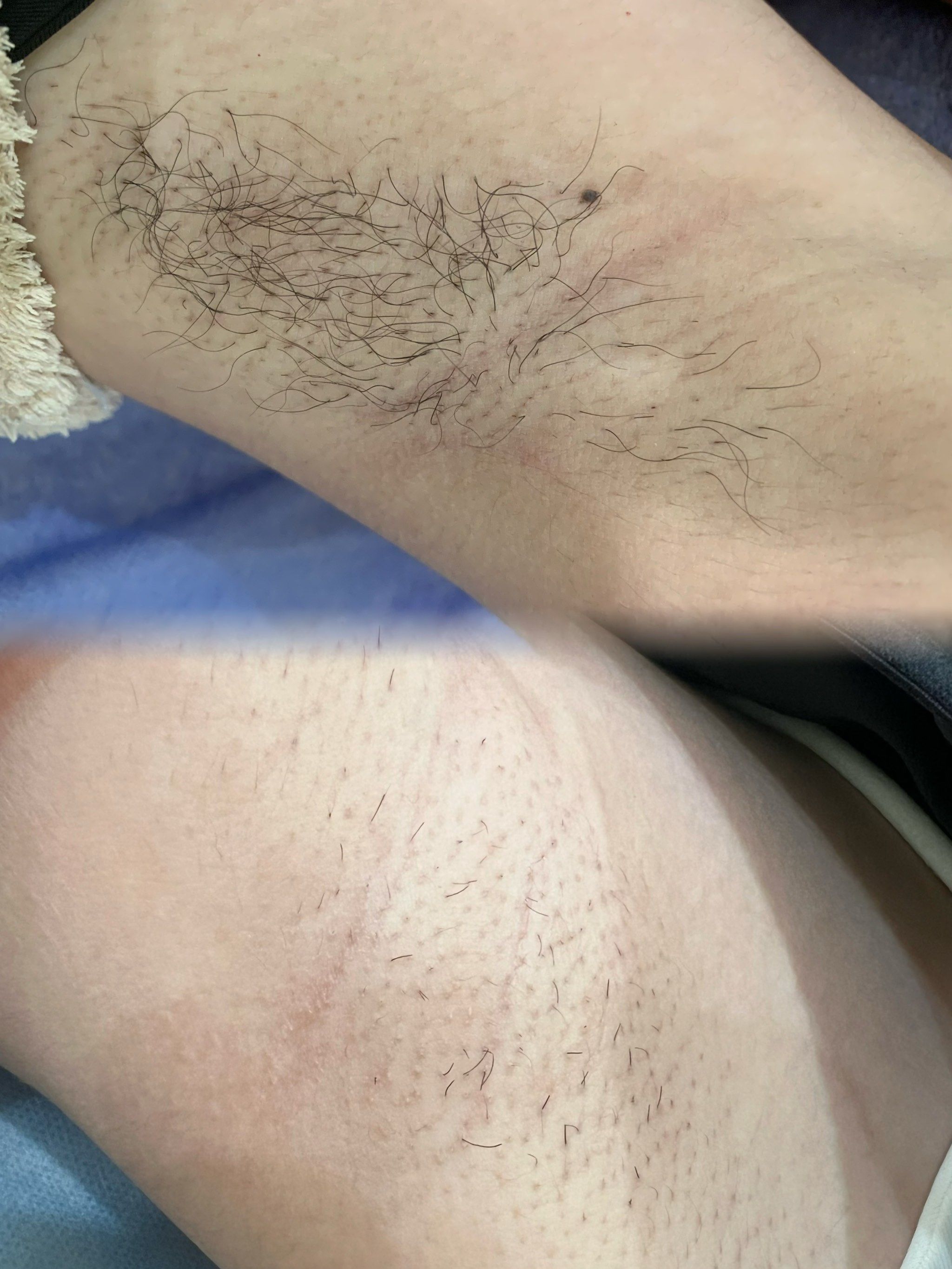 腋下脱毛