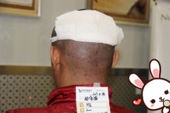 点击看大图 -大麦微针植发丨全国连锁