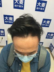 -大麦微针植发丨全国连锁