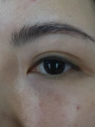 -爱莎扁平疣·汗管瘤·斑痣中心