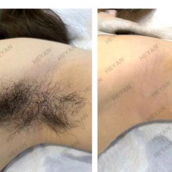 -HEYAN荷妍专业脱毛连锁机构