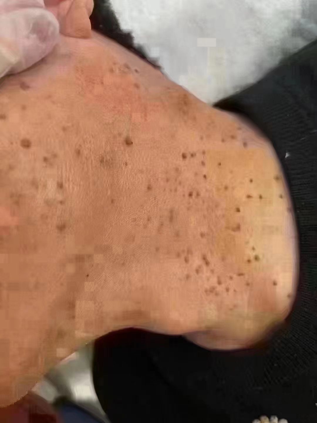 变成一大片
疣是病毒引起,传染力非常强
多发于面部,脖子,手背