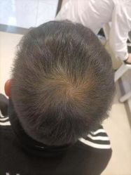 点击看大图 -大麦微针植发丨全国连锁