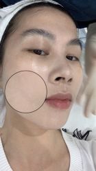 体验后-慕颜医疗美容·皮肤微整 抗衰