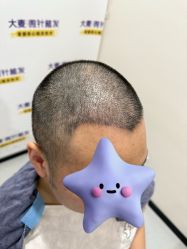 -大麦微针植发全国连锁