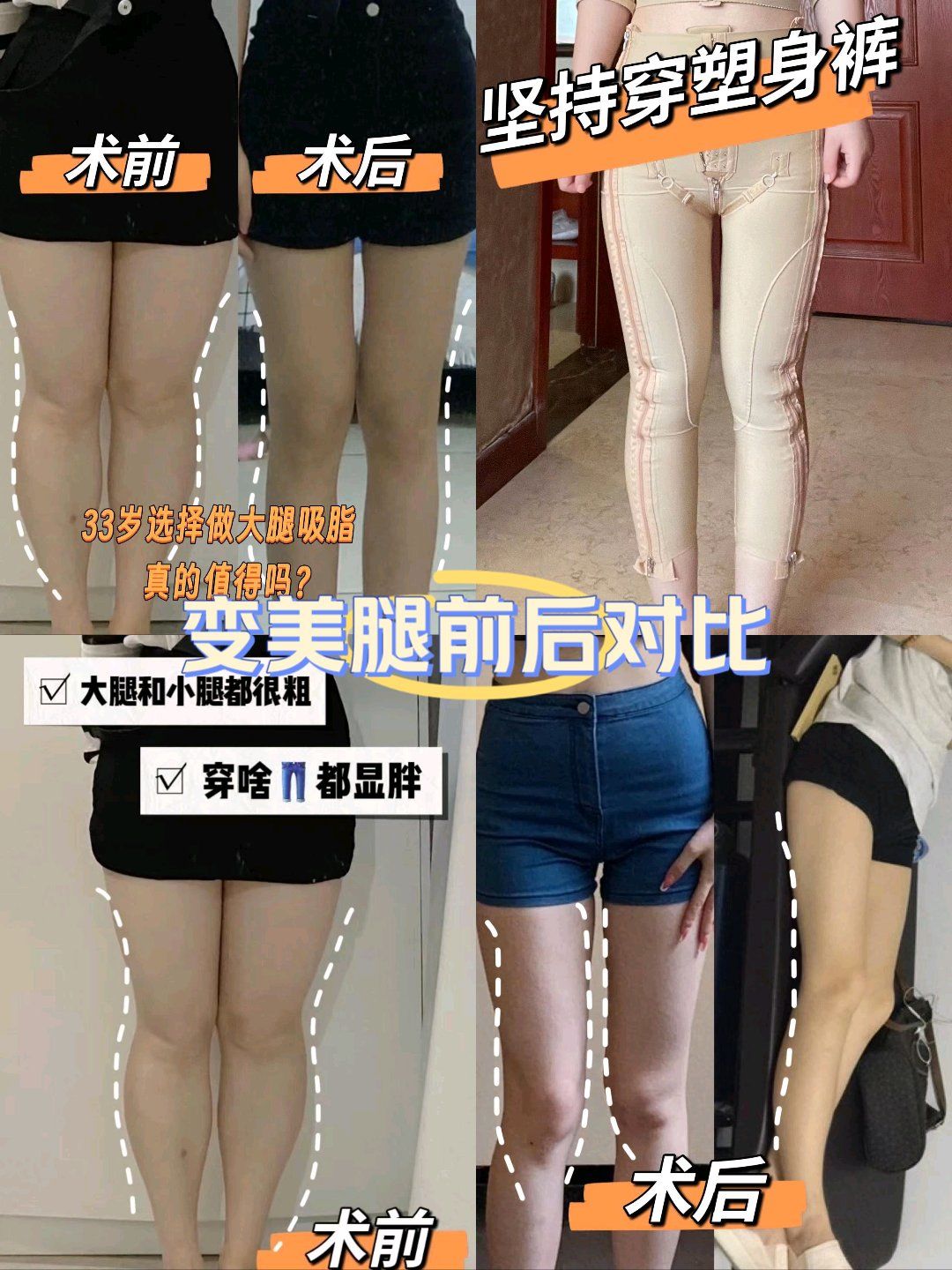 我最终决定尝试通过吸脂手术来改善我的身材比例和外貌