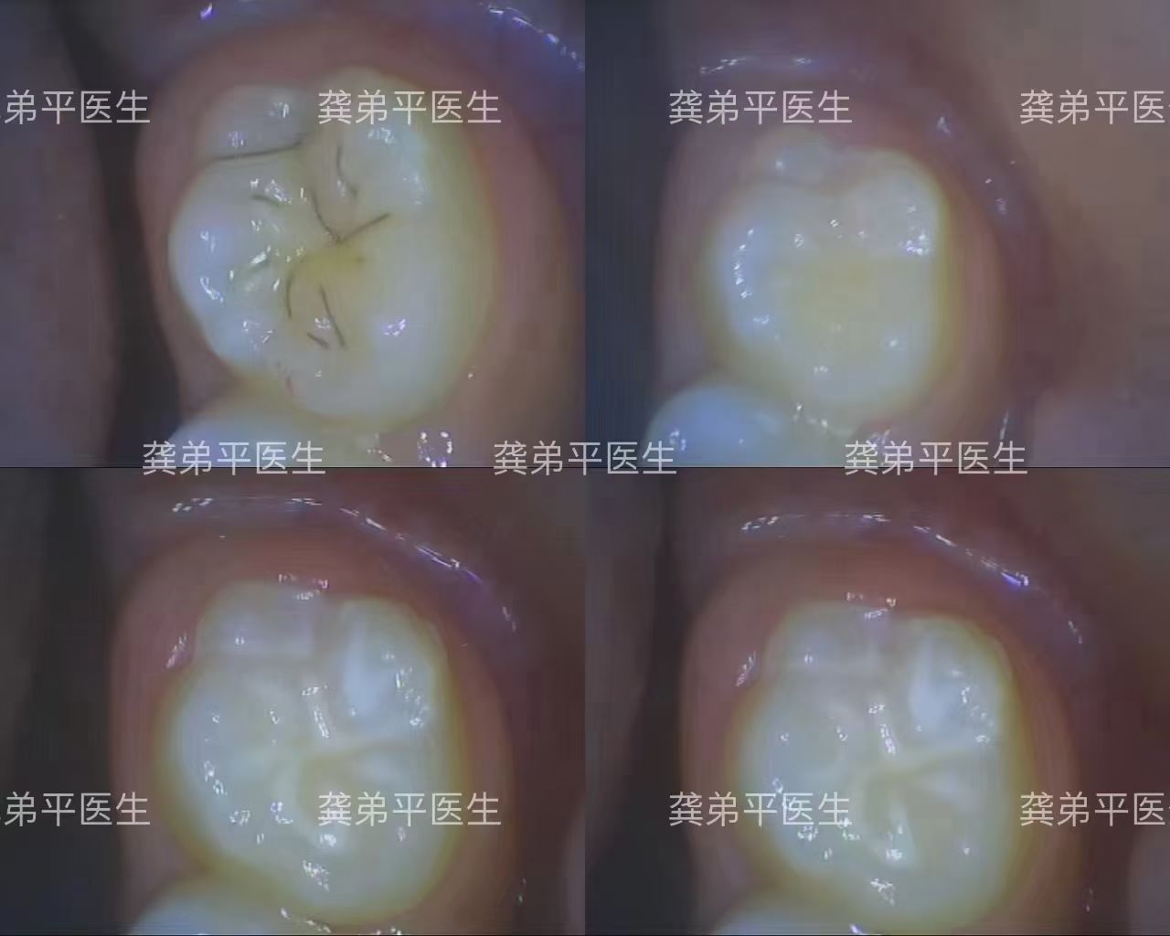 六龄齿发黑图片