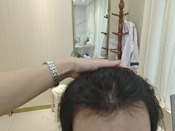 -碧莲盛·不剃发植发