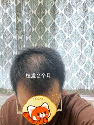 -大麦微针植发丨全国连锁