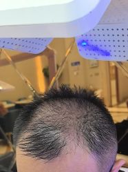 -碧莲盛·不剃发植发