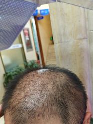 -碧莲盛·不剃发植发