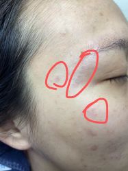 -美丽人生祛斑扁平疣汗管瘤中心