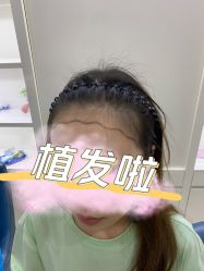 -大麦微针植发丨全国连锁