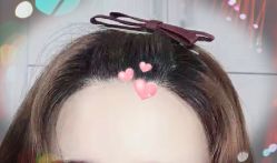 -大麦微针植发全国连锁