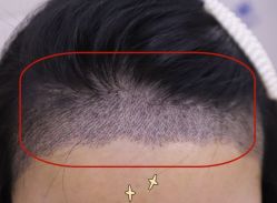 -大麦微针植发全国连锁