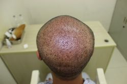 点击看大图 -大麦微针植发丨全国连锁