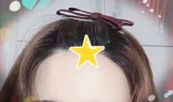 -大麦微针植发全国连锁