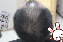 点击看大图 -大麦微针植发丨全国连锁