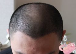 -大麦微针植发丨全国连锁