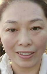 -美丽人生祛斑扁平疣汗管瘤中心