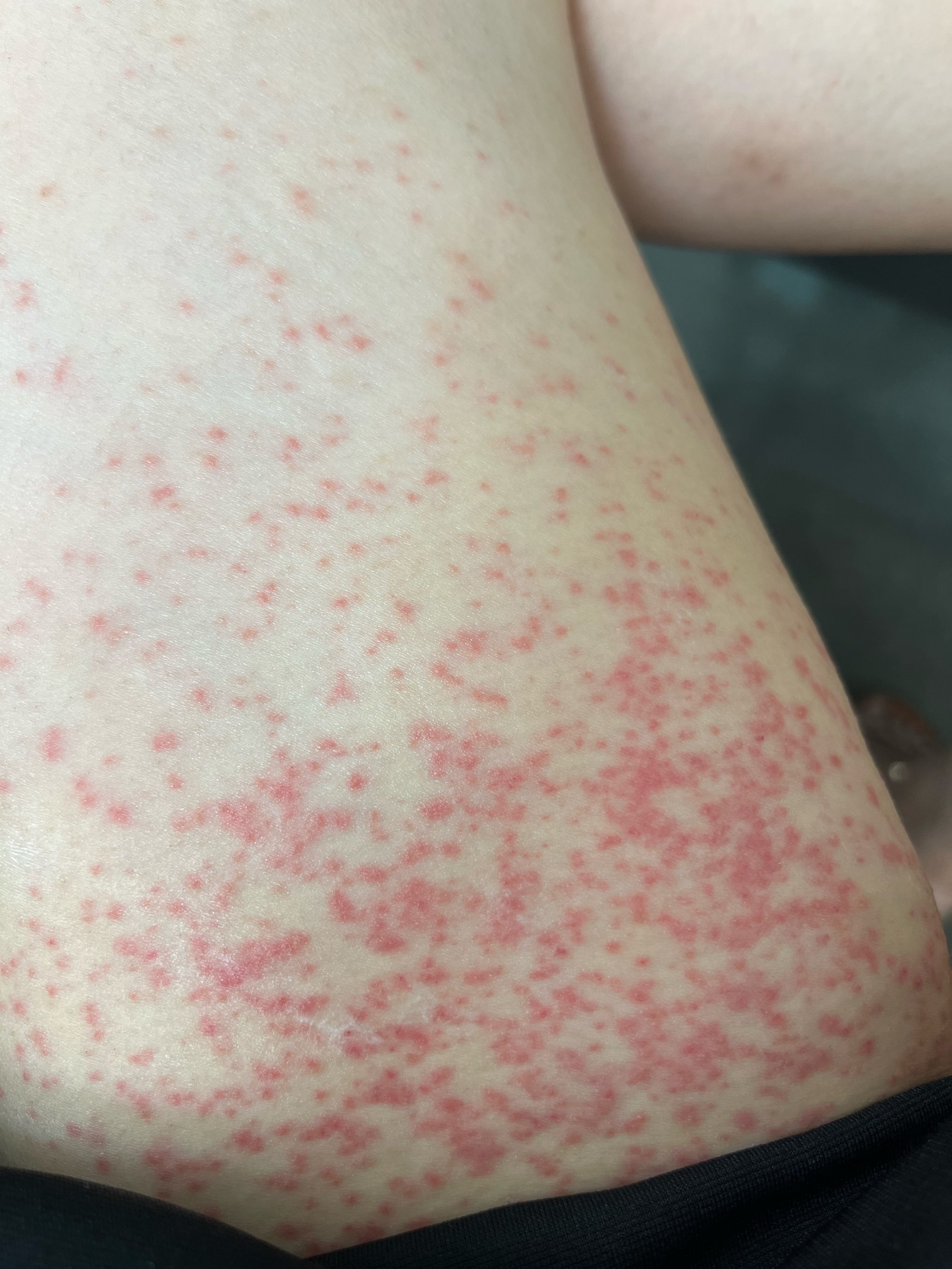 看看这些长满红疹子的照片