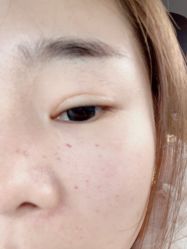 体验后-苏亚医美·高端注射明星整形机构